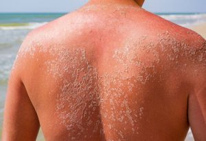 sun-burn