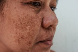 uneven skin tone not using sunscreen